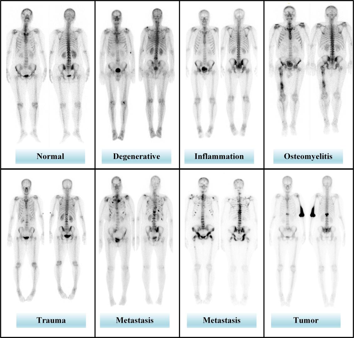 mediso-artificial-intelligence-based-analysis-of-whole-body-bone