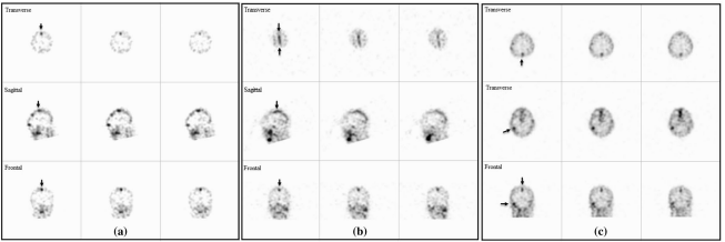 Image of cranial sinus thrombosis in two women with intraparenchymal hemorrhage aged 49 and 31  years (panel a, b) and a man with a retractable headache aged 29 years (c) in transverse, sagittal, and frontal SPECT images 2  h after injection of self-donated 99mTc-HMPAO-labeled platelets. Arrows indicate thrombosis in the sagittal and transverse sinuses